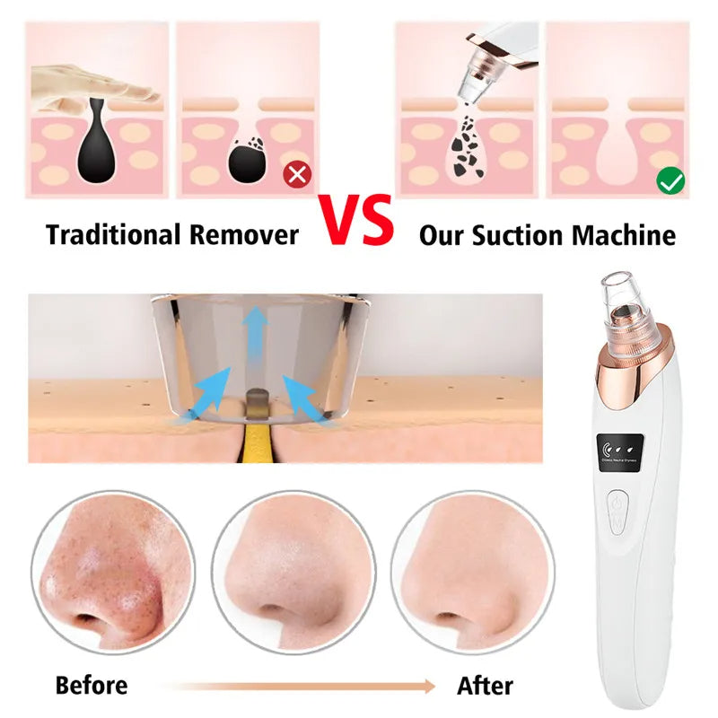 Black Head Remover Chargeable